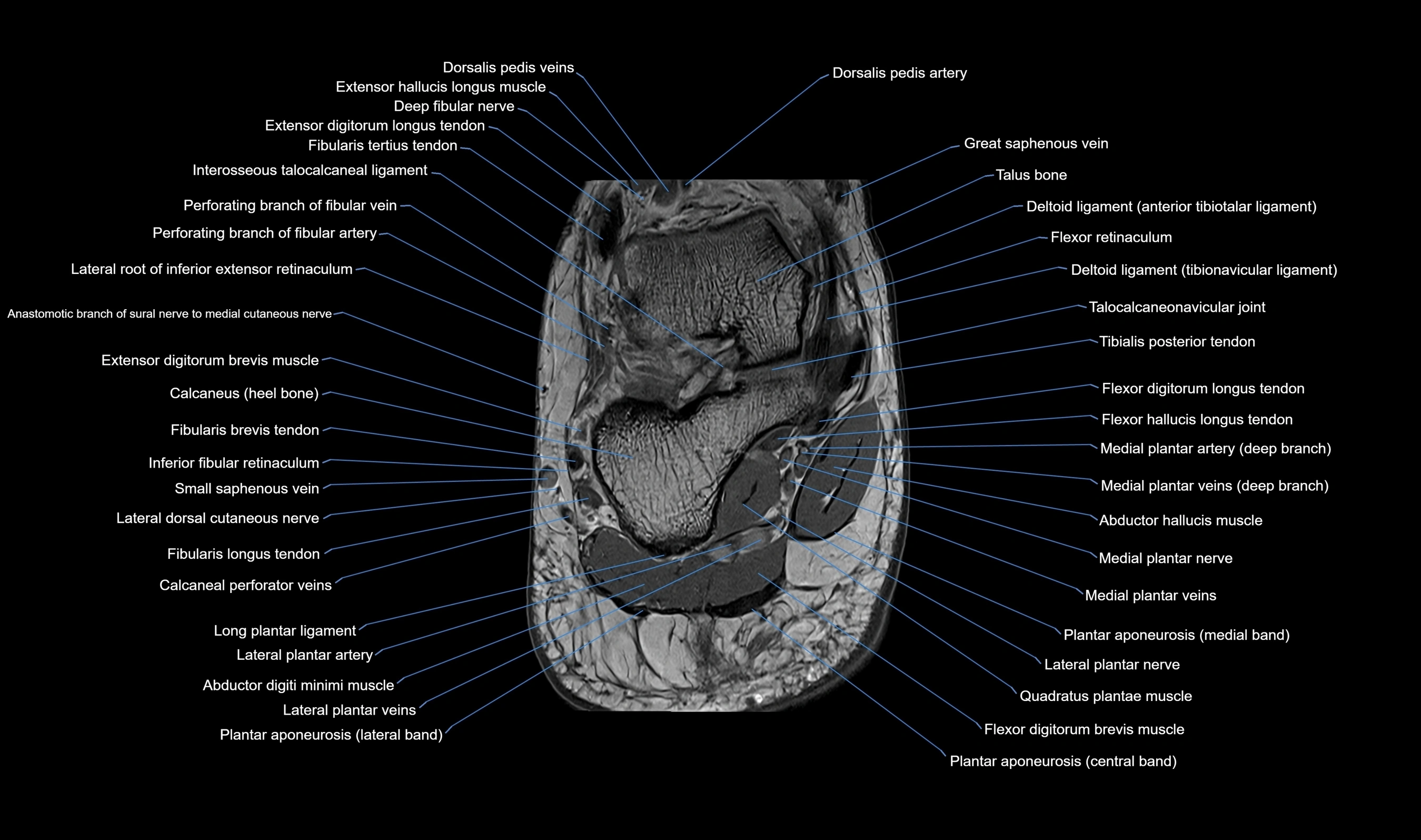 MRI mid foot axial cross sectional anatomy 3T  radiology  image-img-00001-00044.webp